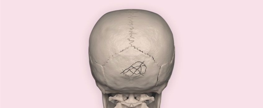 Cranial (Skull) Fractures