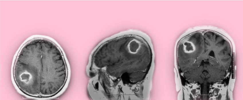 Treatment Options for Epilepsy Caused by Blood Vessel Malformations