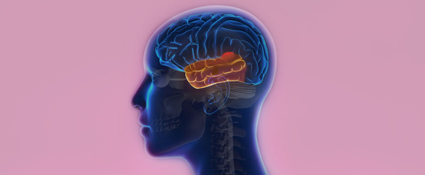 What Is Mesial Temporal Lobe Epilepsy and How Is It Treated?