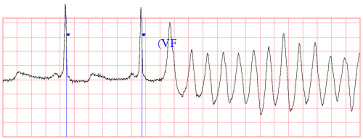 abnormal heart beat abnormal heart beat