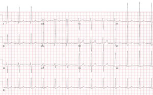 normal heart beat normal heart beat