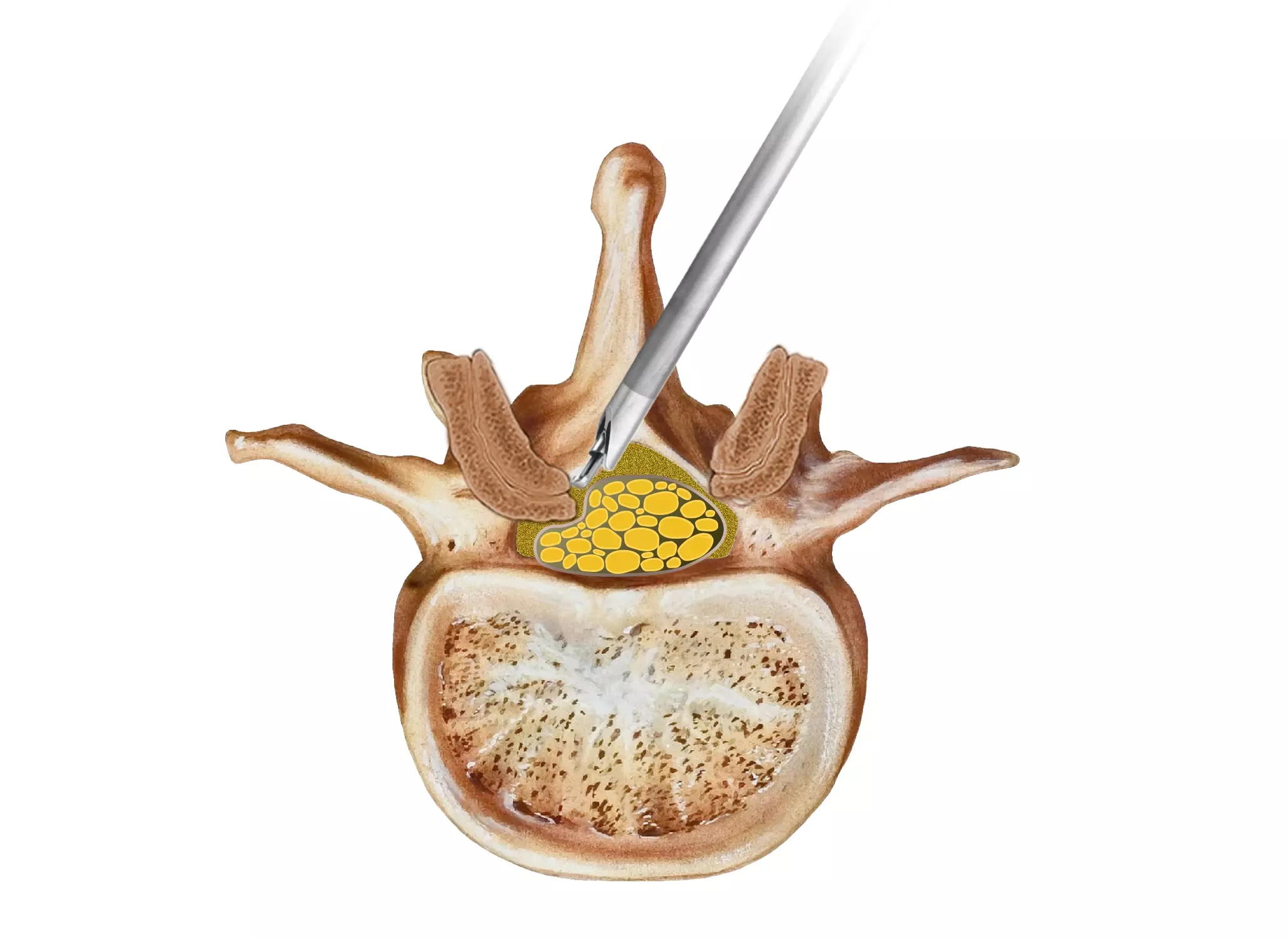 graphic stenosis Endoscopic Spine Surgery