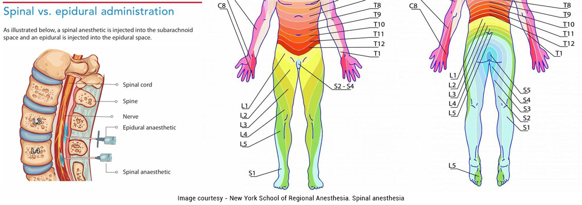 Spinal Anesthesia: Know the Facts