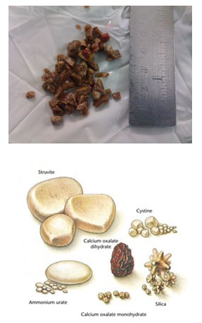 urinary stone 1 urinary stone 1
