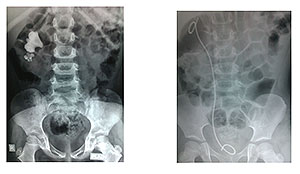 urinary stone 2 urinary stone 2