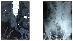 urinary stone 3 urinary stone 3