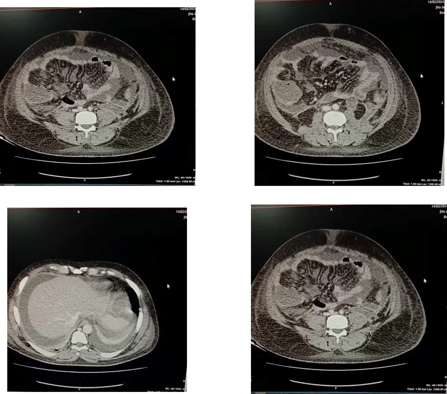 Chest X-ray showing bilateral infiltrates in a patient with acute respiratory distress syndrome.