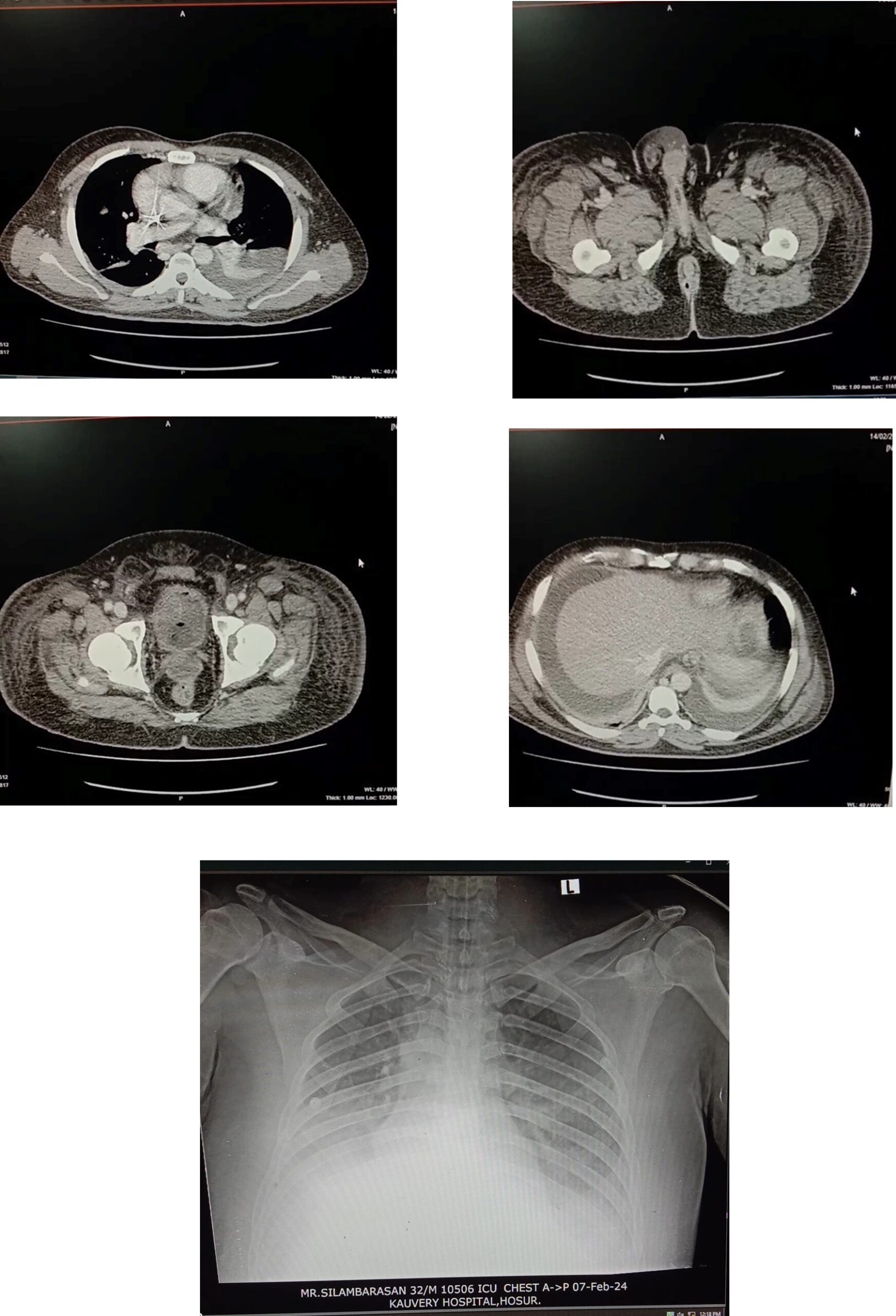 ICU patient receiving mechanical ventilation for severe ARDS with respiratory support equipment visible.
