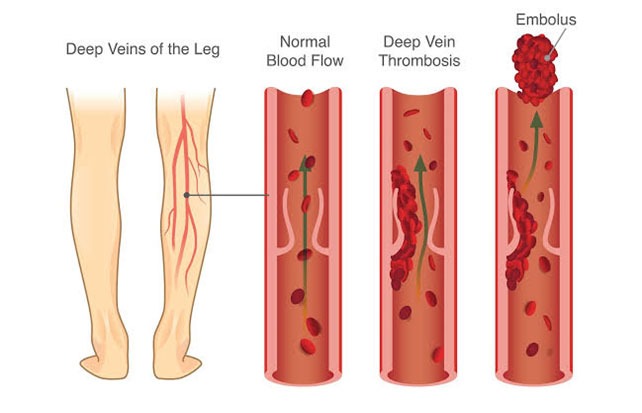 Lower Limb Venous Point-of-Care Ultrasound to Diagnose Deep Vein Thrombosis
