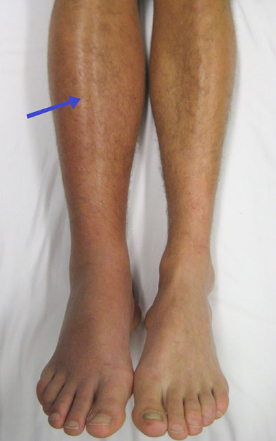 Lower Limb Venous Point-of-Care Ultrasound to Diagnose Deep Vein Thrombosis
