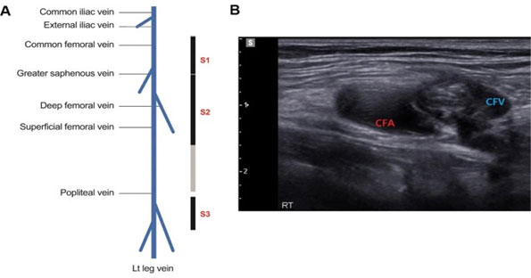 Lower Limb Venous Point-of-Care Ultrasound to Diagnose Deep Vein Thrombosis