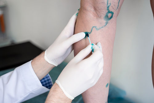 Lower Limb Venous Point-of-Care Ultrasound to Diagnose Deep Vein Thrombosis