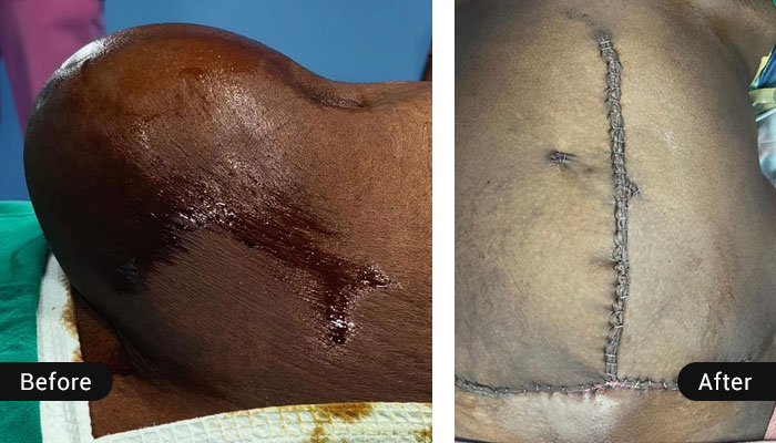 Loss of Domain Hernias