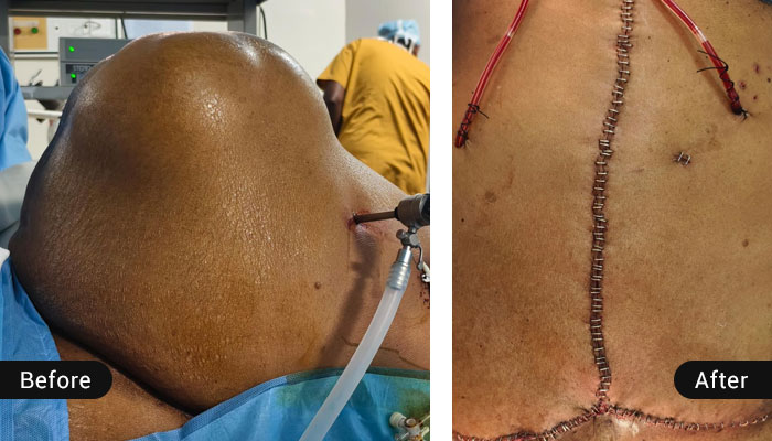 Loss of Domain Hernias