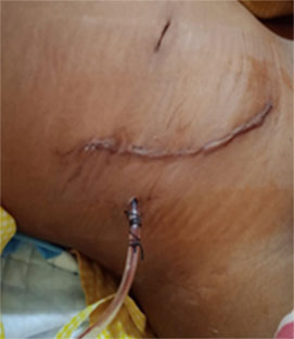 Scar After Open Kidney Transplant