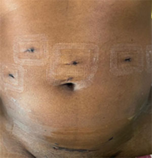 Scar After RAKT