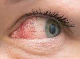 Dry Eye Syndrome