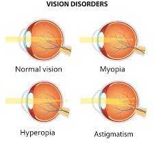 Refractive Errors