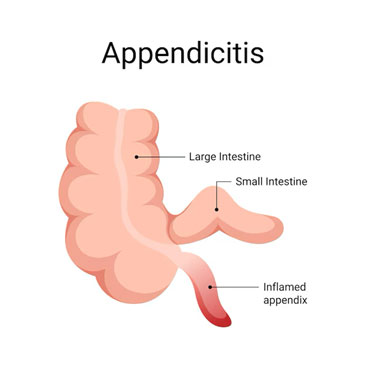 Acute Appendicitis