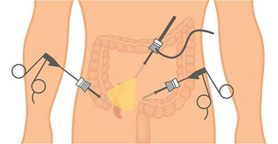 Acute Appendicitis