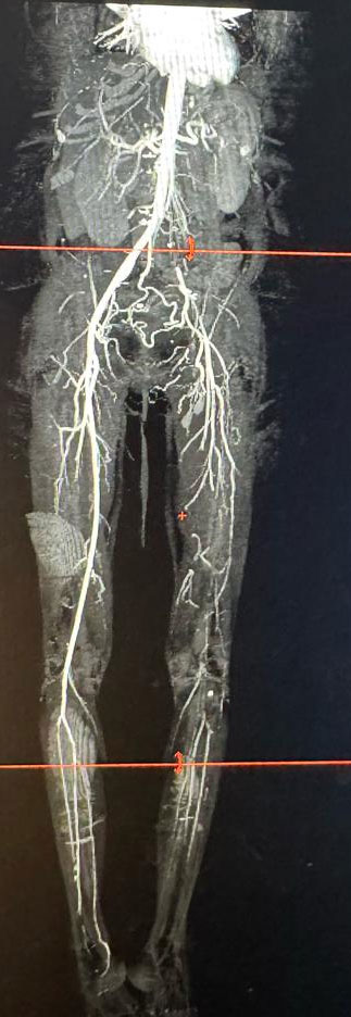 Acute Limb Ischemia