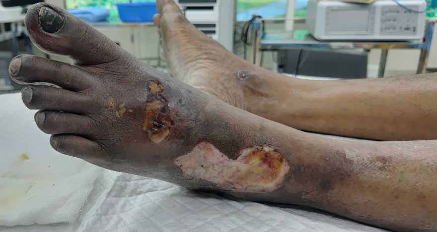 Acute Limb Ischemia