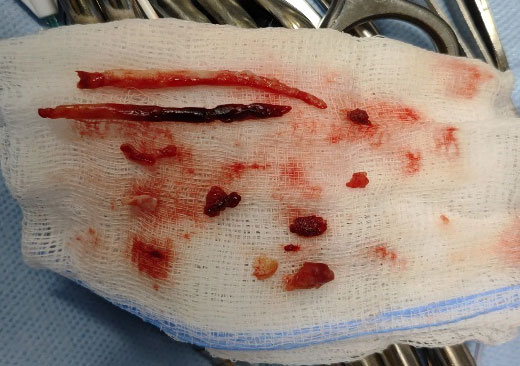 Acute Limb Ischemia