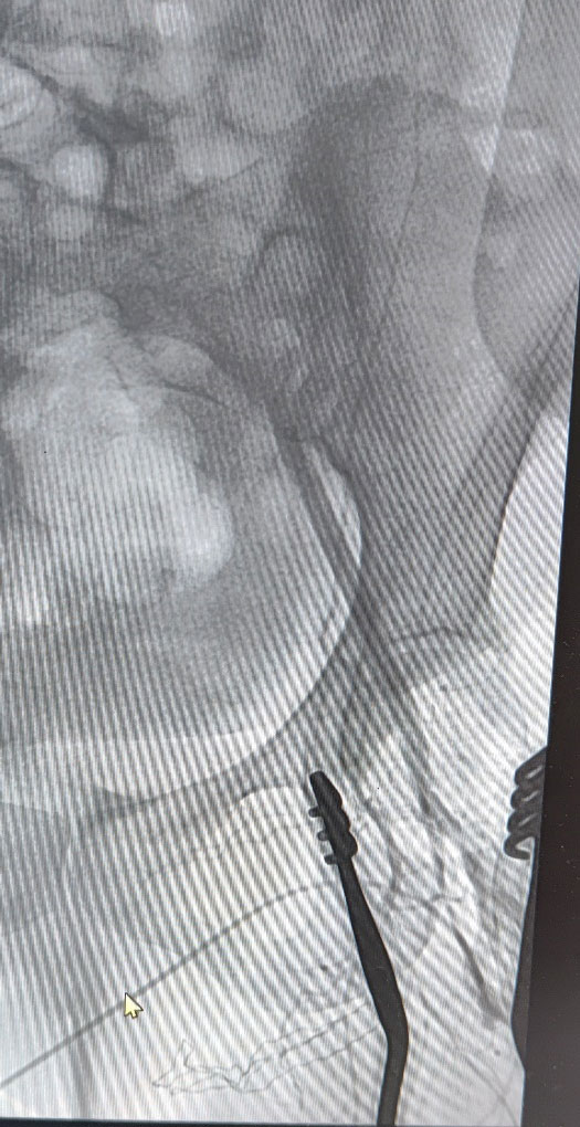 Acute Limb Ischemia