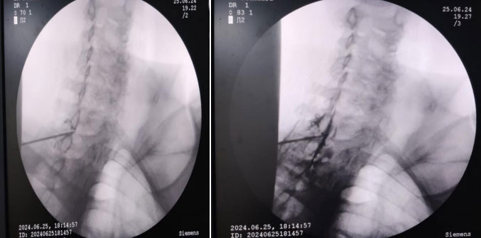 CERVICAL FLUROSCOPY & EPIDUROGRAM