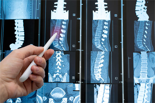 An Update on Epidural Blood Patch