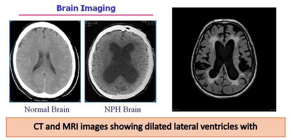 Normal Pressure Hydrocephalus (NPH): A Treatable Cause of Dementia