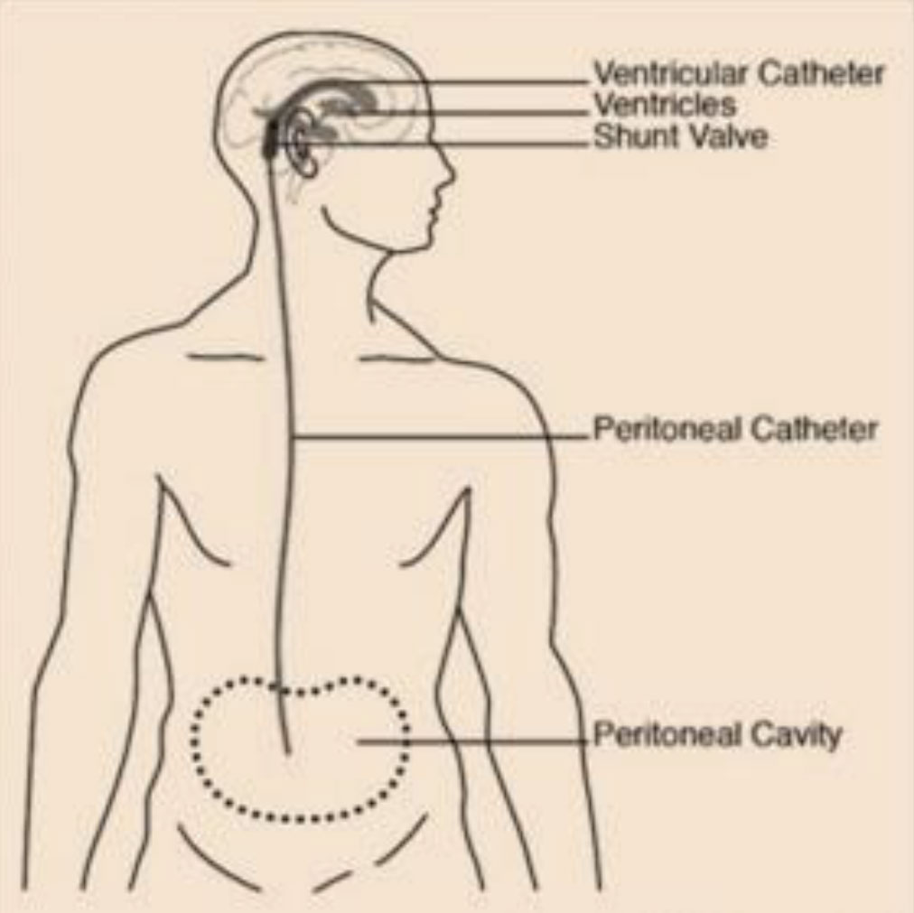 Normal Pressure Hydrocephalus (NPH): A Treatable Cause of Dementia