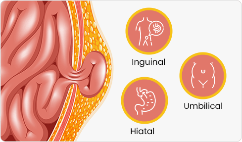 Common Hernia Types