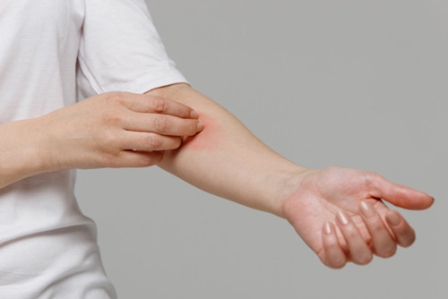 Contact Dermatitis