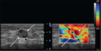Strain Elastography