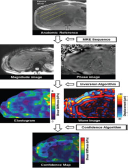 MR Elastography (MRE)