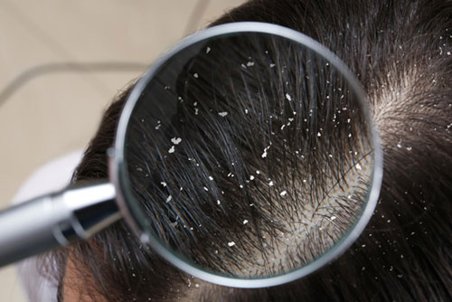 Scalp Conditions Often Mistaken for Dandruff